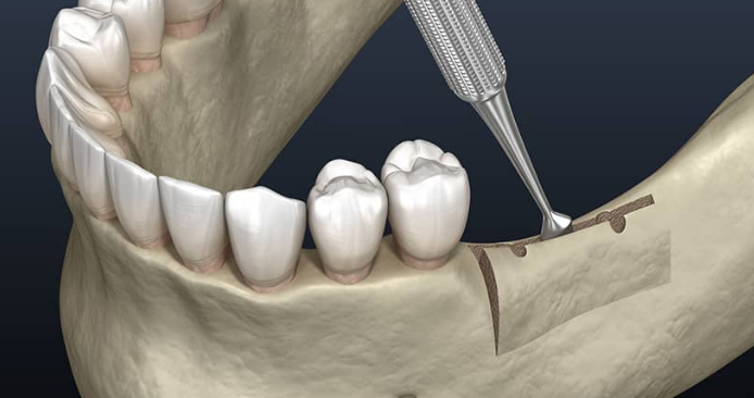 تعزيز حافة الفك