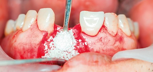 حفظ التجويف