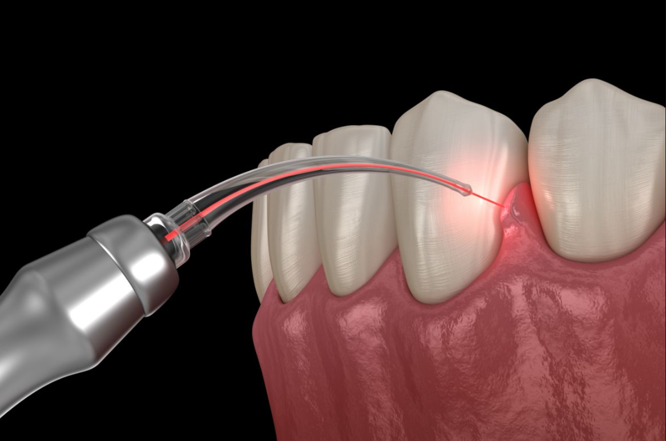 Laser Gum Treatment Technology