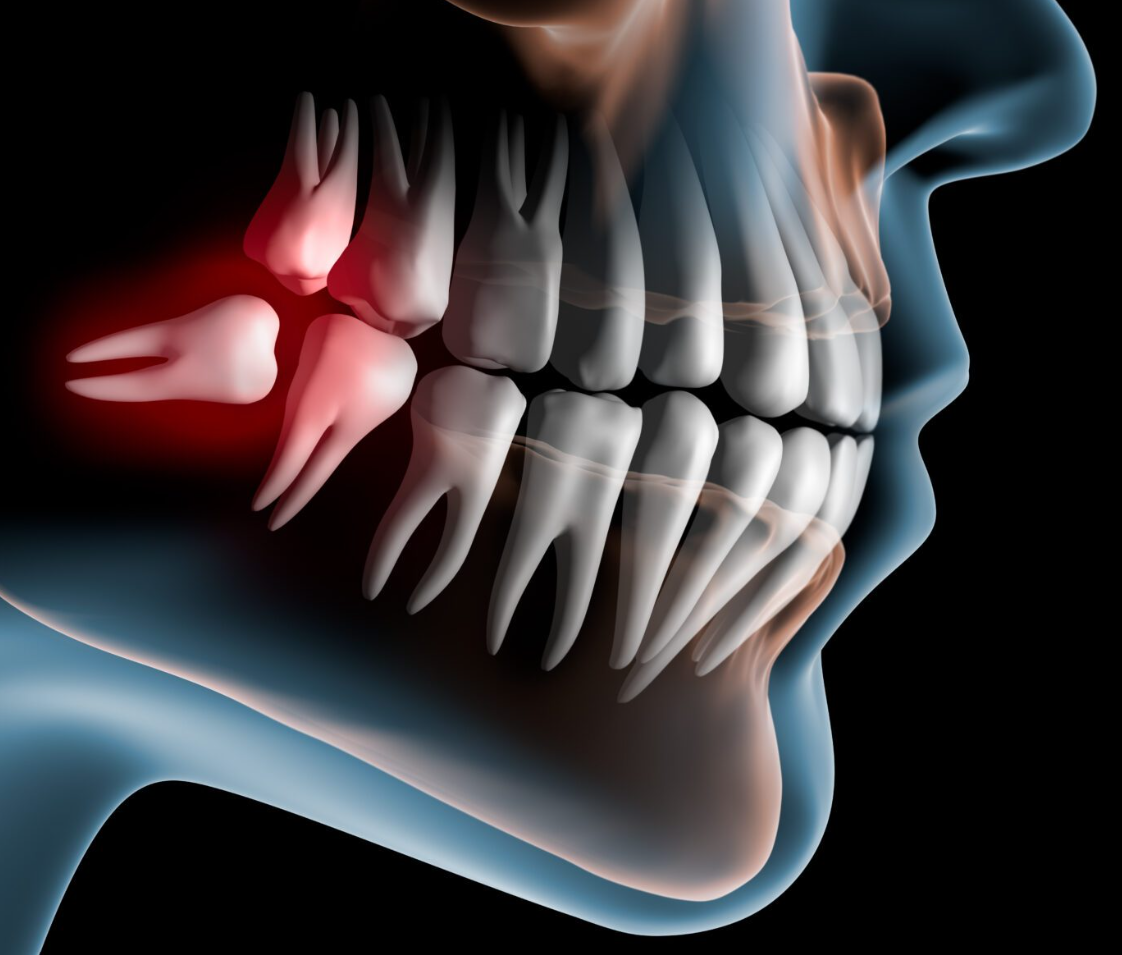 Wisdom Tooth Extraction X-Ray