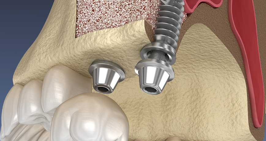 زراعة متزامنة