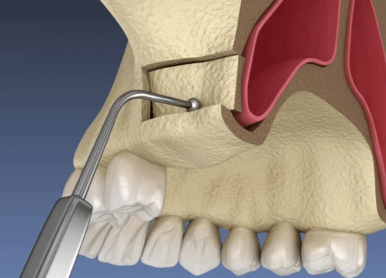 الطريقة الجانبية
